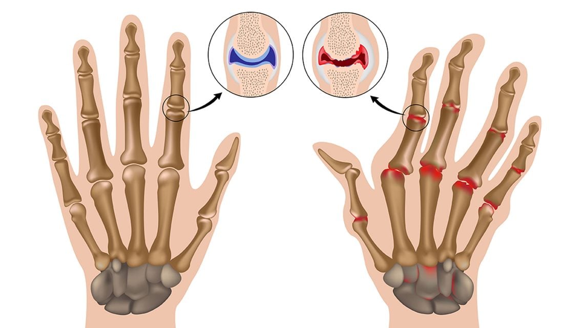 Hand- und Fingerarthrose: Ursachen